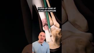 Inside Operating Room: Achilles Rupture Repair⁉️ #shorts