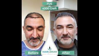 Hair Transplant Turkey, Hair of Zrian, FUE, 4300 Graft