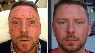 MY SKIN LASER EXPERIENCE! OUCH! BEFORE AND AFTER! WARNING REQUIRED LOL