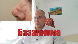 Базалиома - видео о базальноклеточном раке кожи