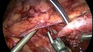 V111 LAPAROSCOPIC RETROPERITONEAL SCHWANNOMA RESECTION