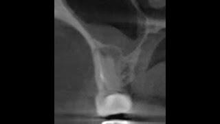 Одонтогенный гайморит на компьютерной томографии. Удаление "кисты" зуба. Периодонтит. Гранулема зуба