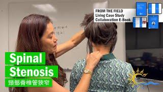 頸部脊椎管狹窄 Left Spinal stenosis#譚針 #韓玉齡  #eileenhan #balancemethodacupuncture #spinalstenosis