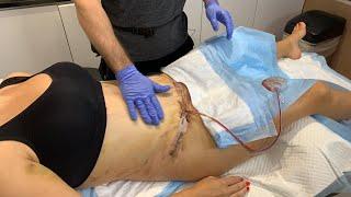 LYMPHATIC MASSAGE TO HEAL QUICKLY AFTER TUMMY TUCK + MOMMY MAKE OVER + FEMALE LIPO | DR. JASON EMER