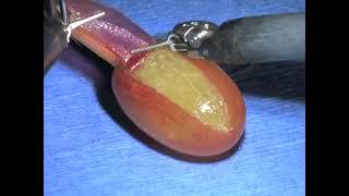 Da vinci system  Robotic surgery on a grape  peeling