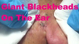 Giant Blackheads  - Part I -