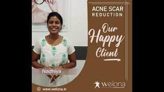 Acne Scar Reduction Testimonial | Acne Scar Treatment in Chennai | Welona Clinic | Acne Treatment