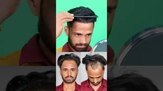 Unbelievable Hair Transplant Result #hair #shorts #ytshortsvideo