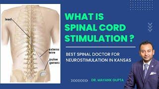 What is Spinal Cord Stimulation | How it is Treatmented - Dr.  Mayank Gupta