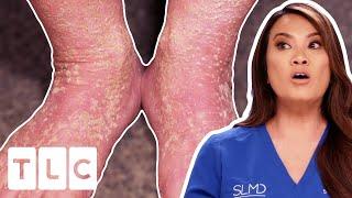 Painful & Peeling Skin Has Kept Man Away From His 7 Adopted Kids | Dr. Pimple Popper