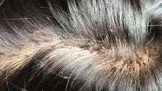 Remove Thousands Of Nits Remove Lice Getting Lice  All From Long Hair