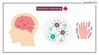 Was ist die Parkinson-Erkrankung?