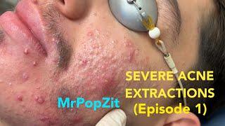 Severe acne extractions episode 1. Comedones and pore dirt removed. Part 1 of 3. So many pops!