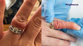 ANGRY FINGER Stuck Ring Removal Using The Ring Rescue Compression Device