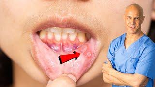 How I Quickly Healed My Canker Sore | Dr. Mandell