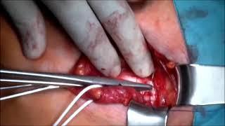 Hernia repair without mesh -Desarda method