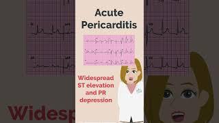 Acute Pericarditis and Myocardial Infarction | PLAB | UKMLA | MedRevisions