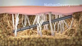 Laser liposuction with collagen fibers and fat cells