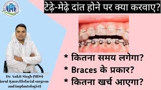 Dental Braces Treatment| Types of Braces, Cost & Duration|| Orthodontic Treatment||