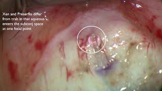 How to Manage Failing Blebs after Traditional and Minimally Invasive Glaucoma Surgery