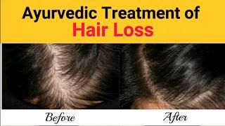 Hair loss Treatment | Scientifically Studied | DocUnlock | Home Ayurveda |