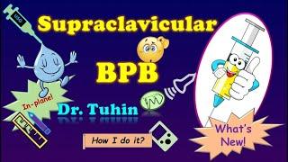 Supraclavicular Brachial Plexus Block |  in-plane | Ultrasound-guided |Subclavian Perivascular Block