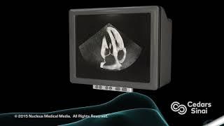 Who is a good candidate for aortic valve repair?–Dr. Pedro Catarino | Aortic Program at Cedars-Sinai