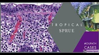 Tropical Sprue