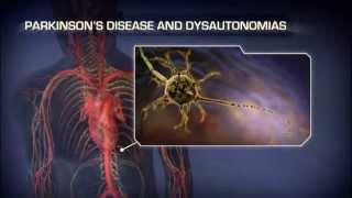 Neurogenic Orthostatic Hypotension - Medical Animation