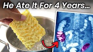 A Boy Ate Instant Noodles for 4 Years, This Is What Happened to His Stomach