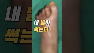 방치하면 발을 잘라야할 수도 있습니다 (당뇨병)