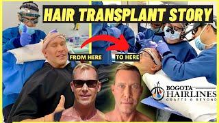 Mamba FUE Hair Transplant Results + Journey STEP BY STEP (Bogota Hairlines, Colombia)