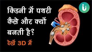 किडनी में पथरी कैसे बनती है और इसे कैसे निकालें - देखें 3D में - Kidney stone treatment in Hindi