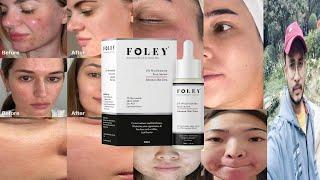 Foley 5% Niacinamide Face Serum | Honest Review