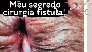 Dr Paulo Branco revela seu segredo sucesso cirurgia fístula perianal ha 37 anos: