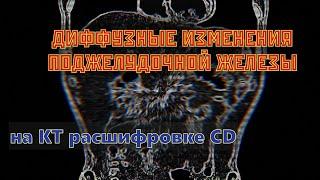 ДИФФУЗНЫЕ ИЗМЕНЕНИЯ ПОДЖЕЛУДОЧНОЙ ЖЕЛЕЗЫ на расшифровке КТ брюшной полости