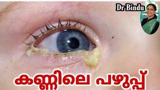 കണ്ണിലെ പഴുപ്പ്/പീള കെട്ടുന്നത്/Eye discharge in children what to do/Dr Bindu