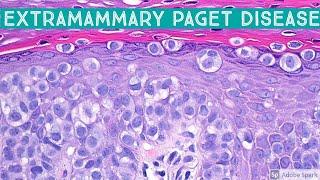 Extramammary Paget disease (presents as chronic "rash" in vulva, scrotum, anus, anogenital area)