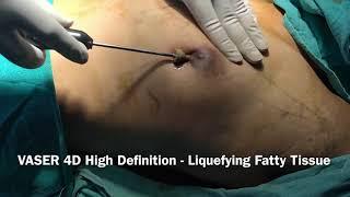 Gynecomastia Surgery at Bliniq Cosmetic Surgery Centre I Dr Ashwani Kumar, Plastic Surgeon