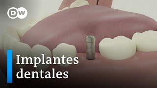 Implantes dentales: ventajas e inconvenientes