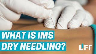 IMS Dry Needling With Your Vancouver Physiotherapist - Everything You Need to Know