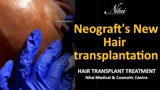 Neograft's New Hair transplantation Solution | Nitai Medical and Cosmetic Centre