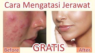 CARA MENGATASI JERAWAT GRATIS !! | MENGHILANGKAN MENYEMBUHKAN JERAWAT dengan 0 RUPIAH !