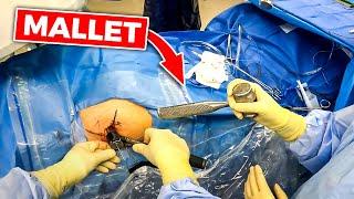 INSIDE THE OR: Sacroiliac Joint Fusion          (Full 25 min surgery)