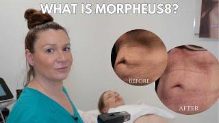 What is morpheus8 treatment? Myths and facts about Morpheus8 celebrity treatment!