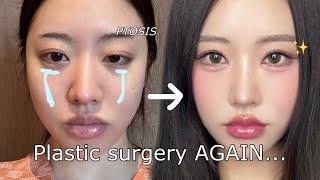 I got my eyes done AGAIN in korea Plastic surgery vlog!