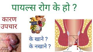 पायल्स रोगको कारण, लक्षण, घरेलु उपचार बिधि / Food for Piles/ Hemorrhoids