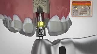 BioHorizons Pro Surgical Kit Drilling Sequence [Keyless Guided Surgery]