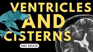 Ventricles and Cisterns of the Brain | Radiology anatomy part 1 prep | MRI brain