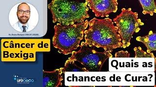 Câncer de Bexiga Tem Cura. Entenda o Diagnóstico e Tipos de Tratamento. Uro- Oncologosta